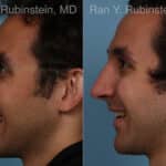 Rhinoplasty Before and After Photos in Newburgh, NY, Patient 23300