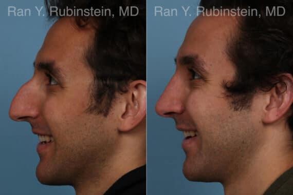 Rhinoplasty Before and After Photos in Newburgh, NY, Patient 23300