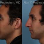 Rhinoplasty Before and After Photos in Newburgh, NY, Patient 23300