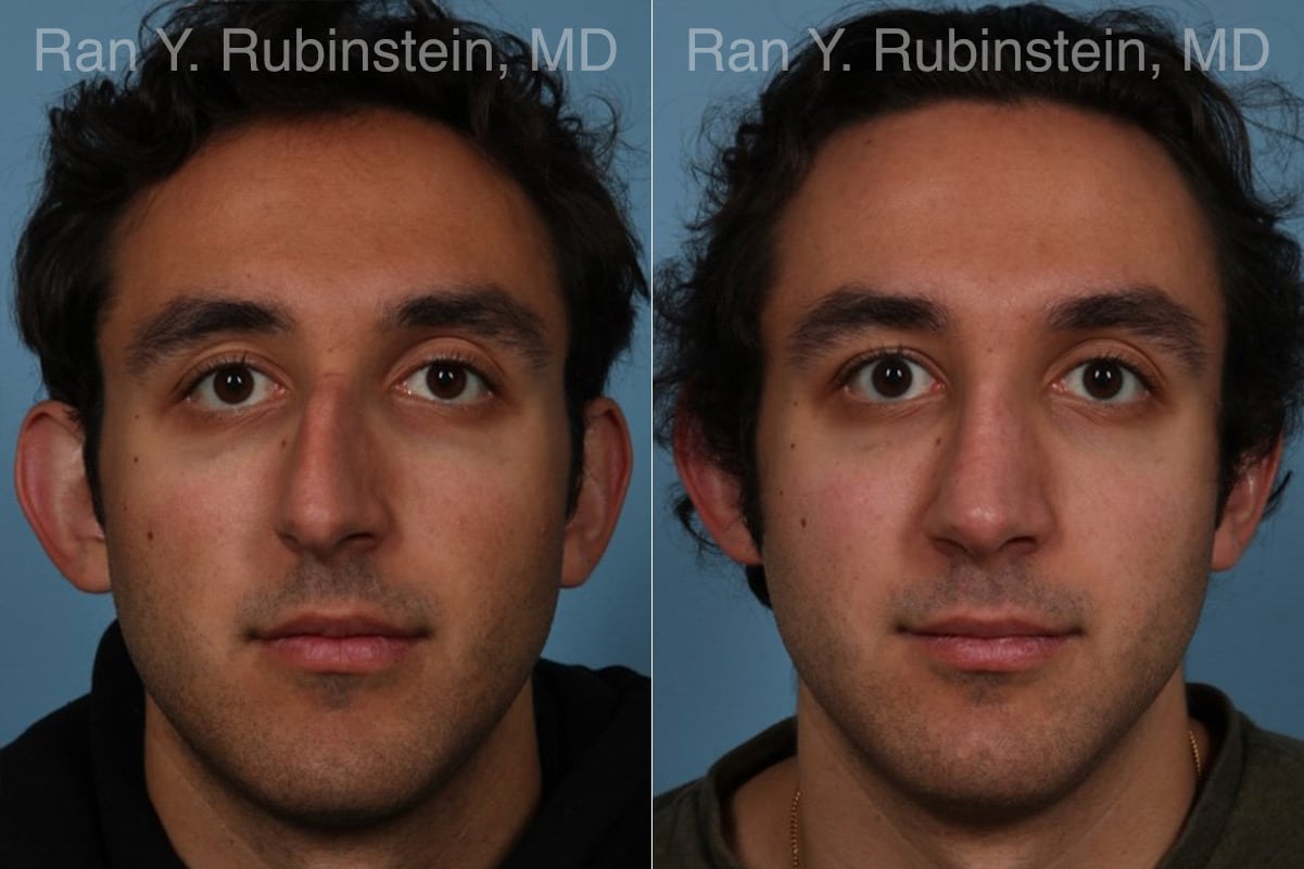 Rhinoplasty Before and After Photos in Newburgh, NY, Patient 23300