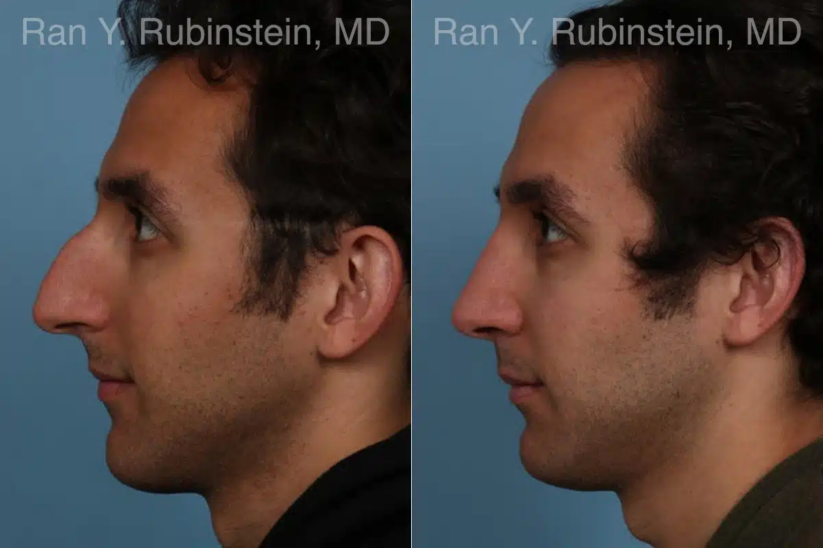 Rhinoplasty Before and After Photos in Newburgh, NY, Patient 23300