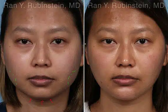 Chin Filler Before & After Photos