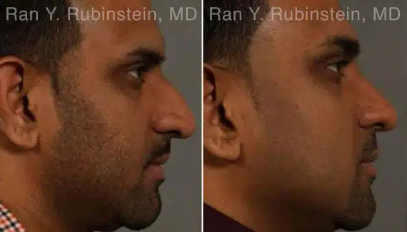 Rhinoplasty Ethnic Before & After Photos