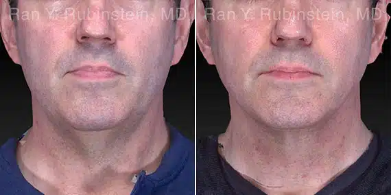 Laser Lift Precision Tx Before & After Photos