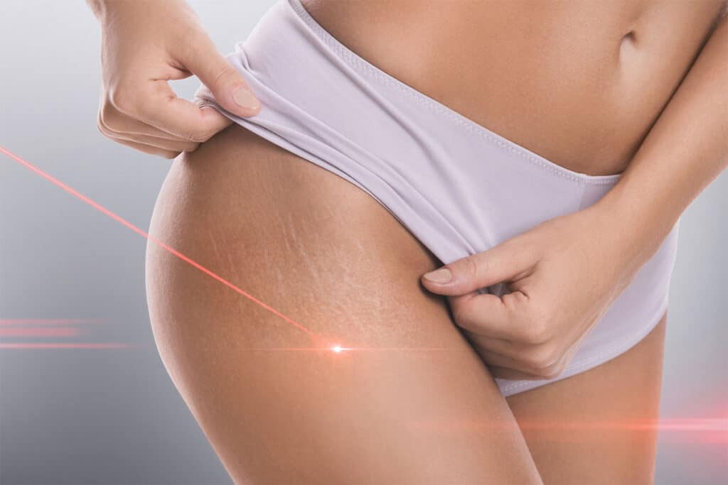 Depiction of how a laser stretch mark removal treatment works.