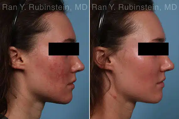 Laser Treatments Before & After Photos