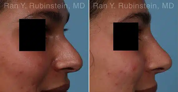 Rhinoplasty Non Surgical Before & After Photos