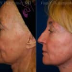 Jawline Filler Before and After Photos in Newburgh, NY, Patient 12779