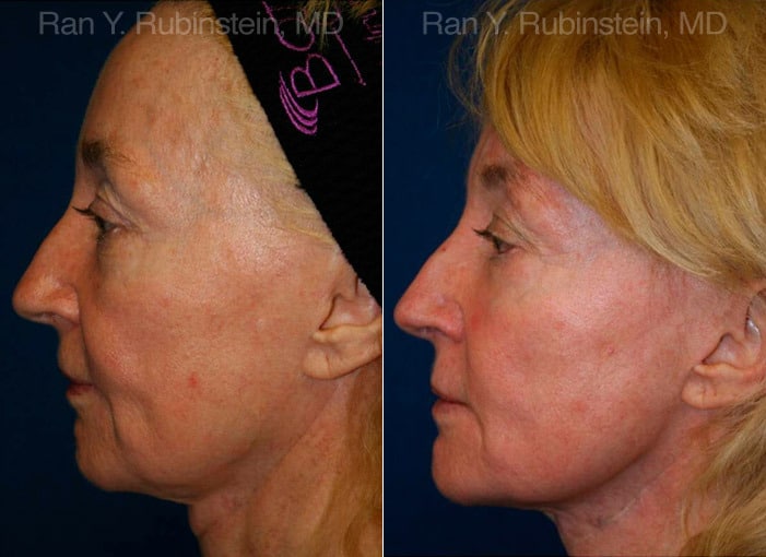 Jawline Filler Before and After Photos in Newburgh, NY, Patient 12779