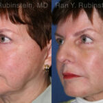 Dermal Fillers Before and After Photos in Newburgh, NY, Patient 12799