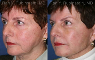 Dermal Fillers Before and After Photos in Newburgh, NY, Patient 12799