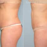 Liposuction Before and After Photos in Newburgh, NY, Patient 12898