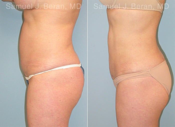 Liposuction Before and After Photos in Newburgh, NY, Patient 12898