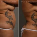 Smart Lipo Body Before and After Photos in Newburgh, NY, Patient 13222