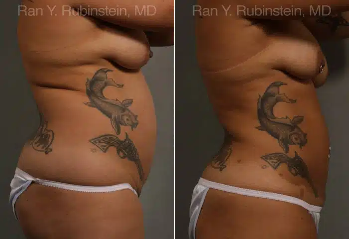 Smart Lipo Body Before and After Photos in Newburgh, NY, Patient 13222