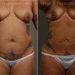 Smart Lipo Body Before and After Photos in Newburgh, NY, Patient 13222