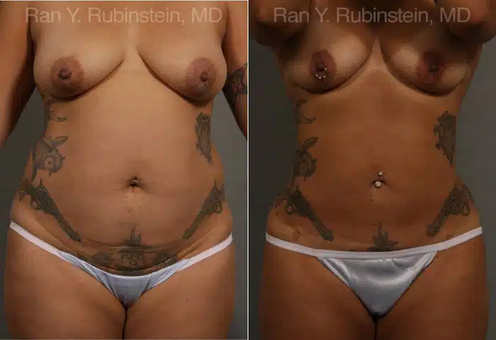 Smart Lipo Body Before and After Photos in Newburgh, NY, Patient 13222