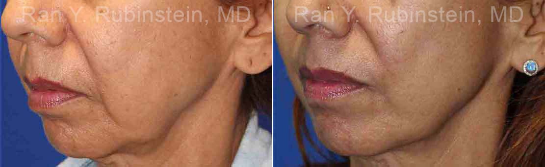 Microneedling RF Before and After Photos in Newburgh, NY, Patient 16594