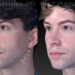 Chin Filler Before and After Photos in Newburgh, NY, Patient 19962