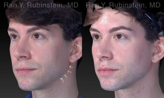 Chin Filler Before and After Photos in Newburgh, NY, Patient 19962