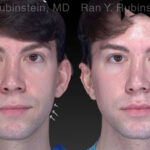 Chin Filler Before and After Photos in Newburgh, NY, Patient 19962