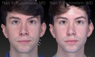 Chin Filler Before and After Photos in Newburgh, NY, Patient 19962