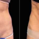 Emsculpt Before and After Photos in Newburgh, NY, Patient 23533