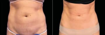 Emsculpt Before and After Photos in Newburgh, NY, Patient 23533