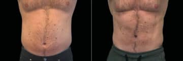 Emsculpt Before and After Photos in Newburgh, NY, Patient 23537