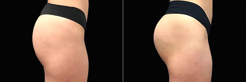 Emsculpt Before and After Photos in Newburgh, NY, Patient 23541