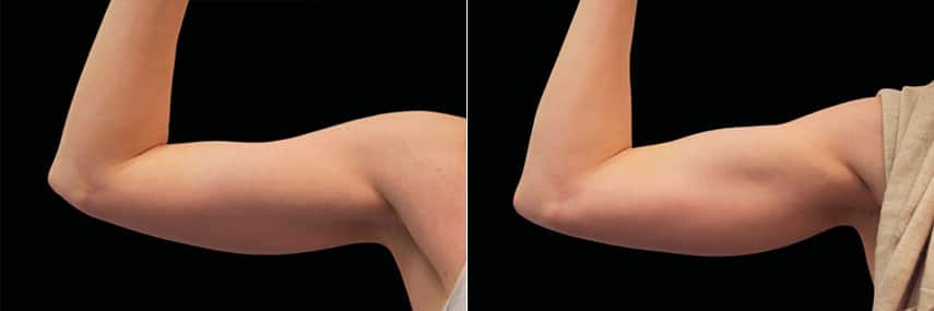 Emsculpt Before and After Photos in Montvale, NJ, Patient 23545
