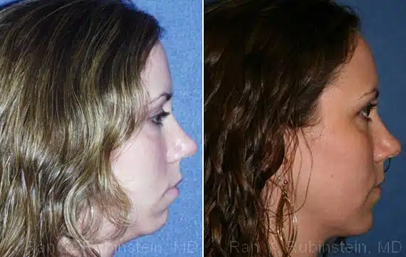 Smart Lipo Neck Before & After Photos