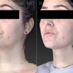 Kybella Before and After Photos in Newburgh, NY, Patient 23658