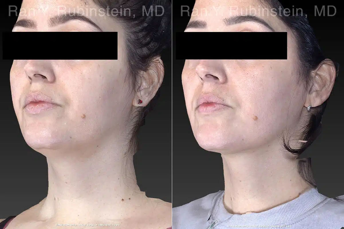 Kybella Before and After Photos in Newburgh, NY, Patient 23658