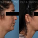 Kybella Before and After Photos in Newburgh, NY, Patient 23658