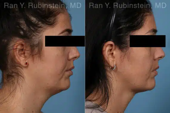 Kybella Before and After Photos in Newburgh, NY, Patient 23658