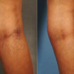 Spider Veins Before and After Photos in Newburgh, NY, Patient 23701