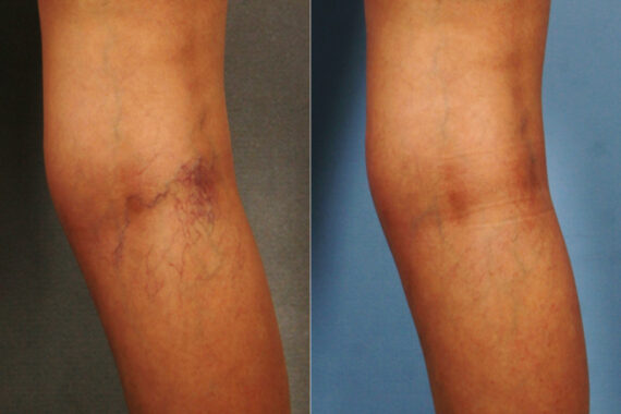 Spider Veins Before and After Photos in Newburgh, NY, Patient 23701