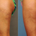 Spider Veins Before and After Photos in Newburgh, NY, Patient 23701