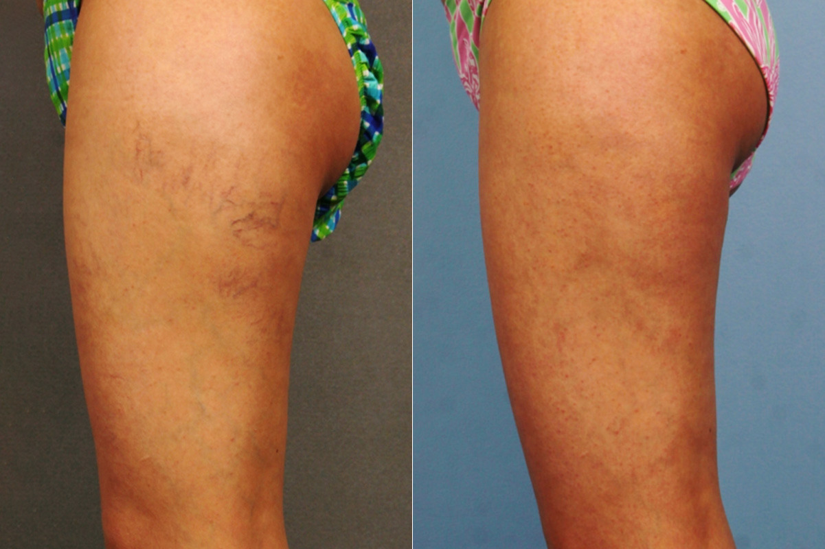 Spider Veins Before and After Photos in Newburgh, NY, Patient 23701