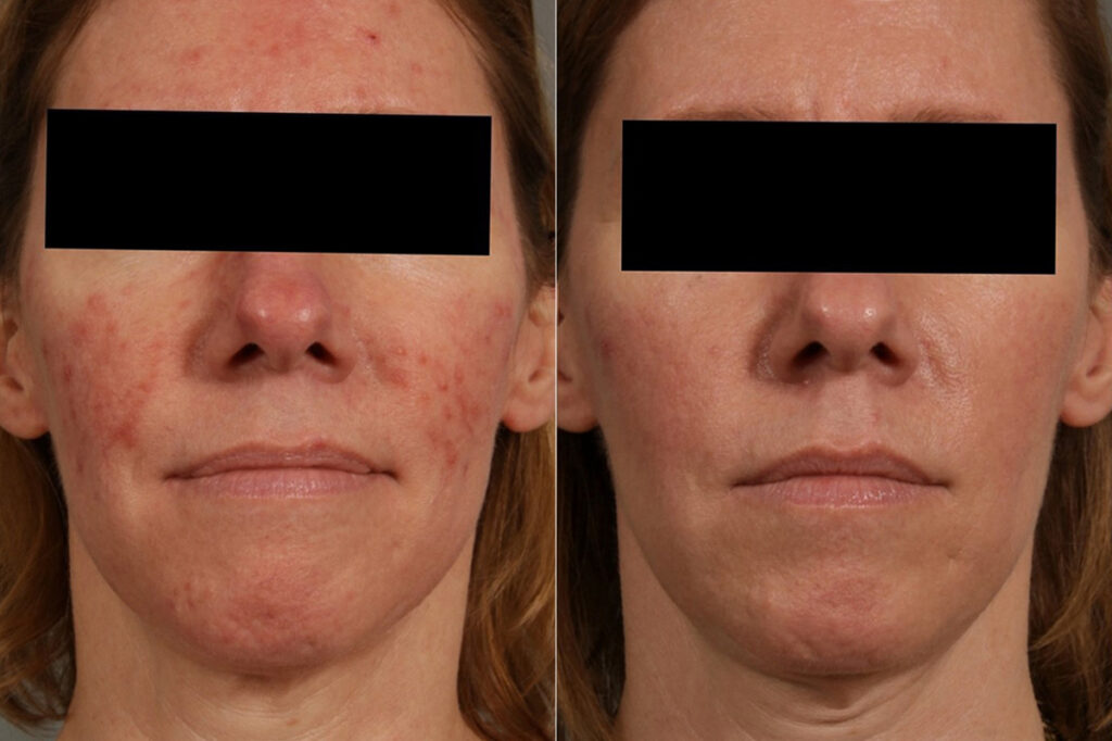 Laser Treatments Before & After Photos Newburgh, NY