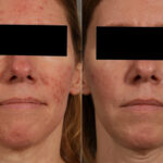 Laser Treatments Before and After Photos in Newburgh, NY, Patient 23709