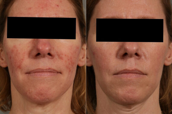 Laser Treatments Before and After Photos in Newburgh, NY, Patient 23709