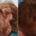 PRP Hair Restoration Before and After Photos in Newburgh, NY, Patient 23736