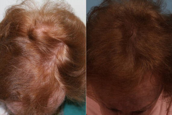 PRP Hair Restoration Before and After Photos in Newburgh, NY, Patient 23736