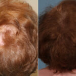 PRP Hair Restoration Before and After Photos in Newburgh, NY, Patient 23736