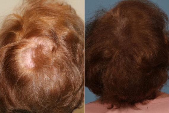 PRP Hair Restoration Before and After Photos in Newburgh, NY, Patient 23736