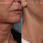 Microneedling RF Before and After Photos in Newburgh, NY, Patient 23835