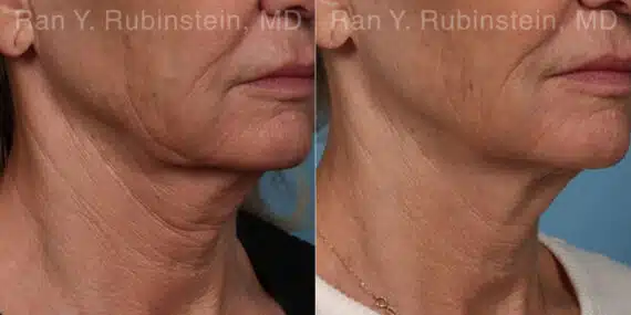 Microneedling RF Before and After Photos in Newburgh, NY, Patient 23835