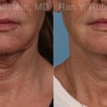 Microneedling RF Before and After Photos in Newburgh, NY, Patient 23835